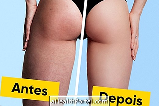 What is and how the thigh lift is done