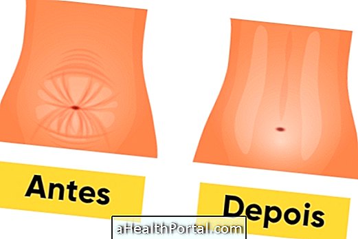 Hvordan er mini abdominoplasty gjort og hvordan er genopretning