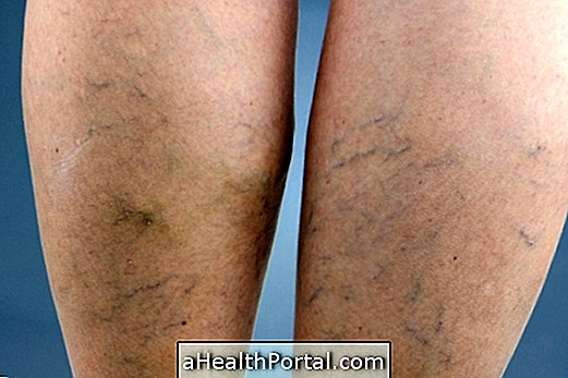 5 Options for surgery for varicose veins