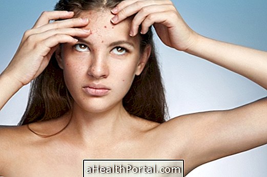 Sådan behandles tør og acne hud