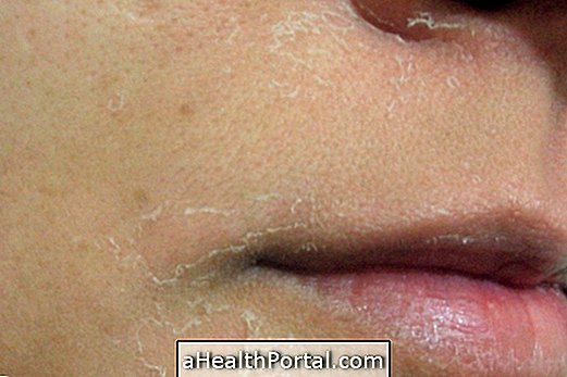 10 Almindelige årsager til blæret hud