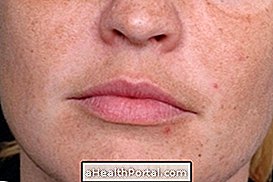 Crystal Peeling entfernt Flecken und verringert die erweiterten Poren