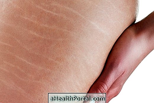Best creams for stretch marks