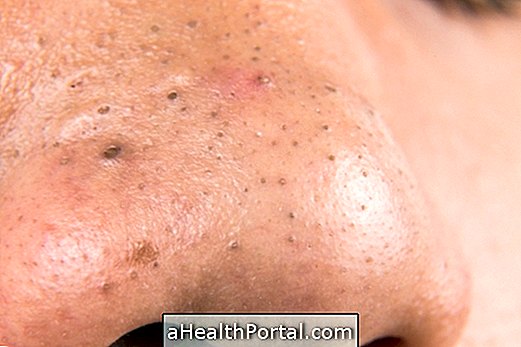 Sådan fjerner du hudorme og bumser fra næsen