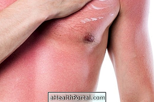 How to relieve the pain of sunburn