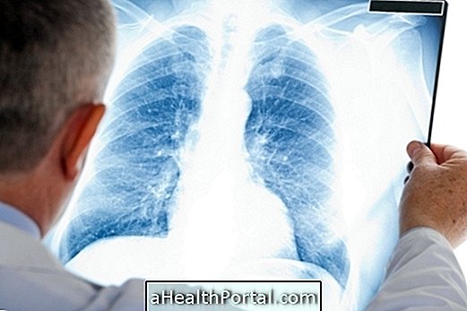 Mikä on SARS: akuutti hengityselinten oireyhtymä