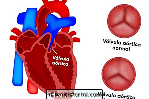 Hvad forårsager en bicuspid Aortic Valve og hvordan man behandler det