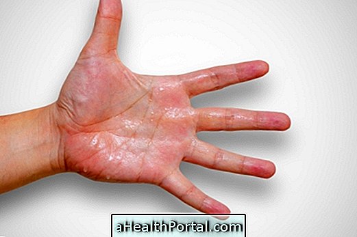 Kako zaustaviti znojenje u vašim rukama