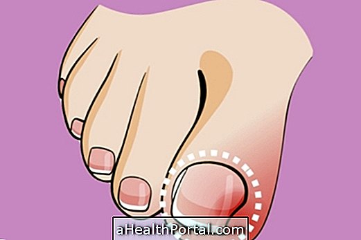 Kuku jari: Cara merawat dan Remedies