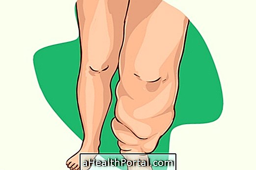 What is Lymphedema and how to treat it