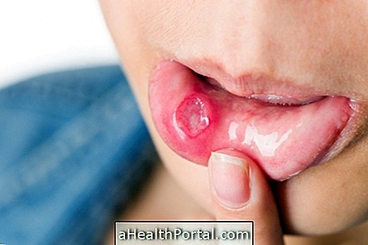 Kaj lahko in kako zdraviti bolecino v ustih