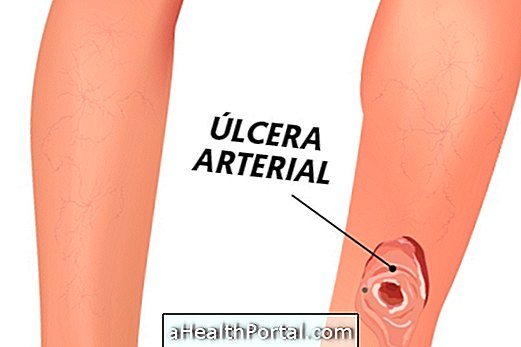 How to treat an arterial ulcer