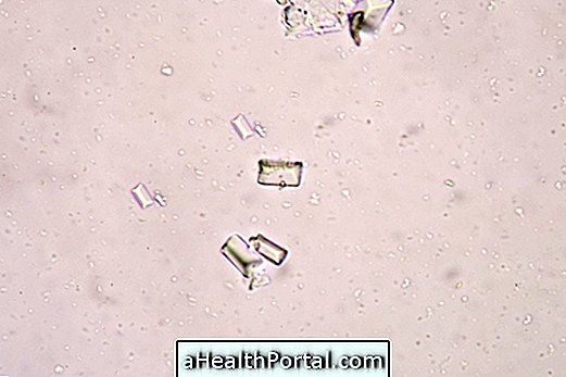 Hvad kan krystallerne i urinen og mulige symptomer være