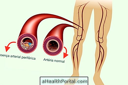Mis on perifeersete arterite haigused ja kuidas neid tuvastada