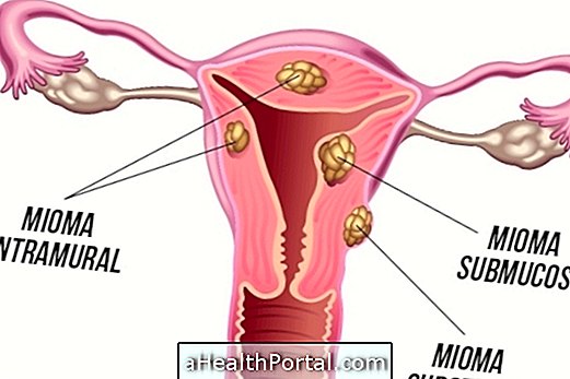 Parandused Myoma jaoks uterus