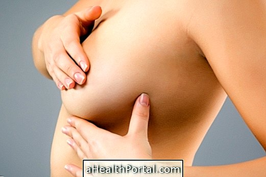 Engorgement du sein: qu'est-ce que c'est, symptômes clés et quoi faire