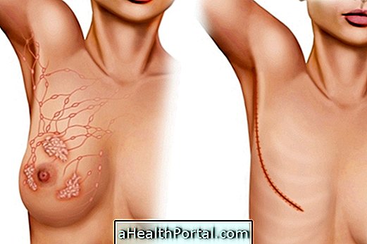 5 hovedtyper af mastektomi og hvordan de er lavet