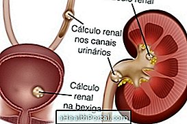 Kidney calculus: what it is and how to avoid