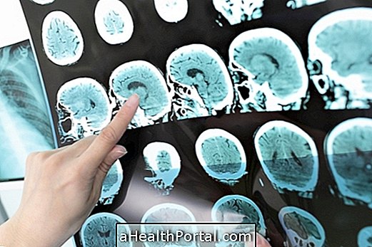 Comment identifier et traiter un mini-accident vasculaire cérébral