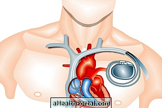 Cardiale pacemaker: wat is het en zorg na plaatsing