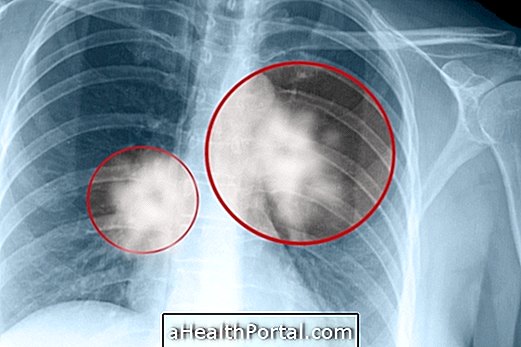 Lung Spot: Τι μπορεί να είναι