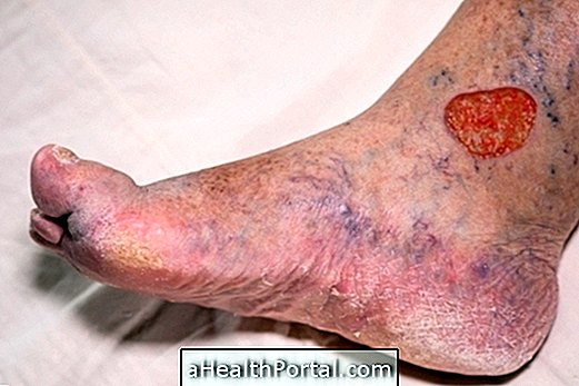 What is venous ulcer and how is the treatment done?