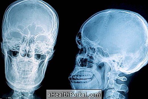 Cranial fraktur: Hvad det er, symptomer og behandling
