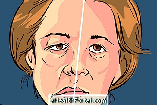 Kas ir sejas paralīze (Bell's) un kā to ārstēt