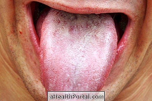 What is leukoplakia and how to treat it