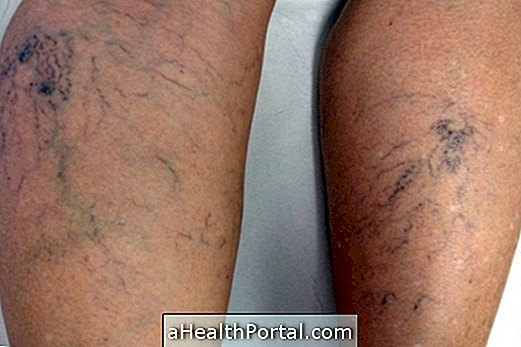 Varicose veins: how the treatment is done, main symptoms and possible complications