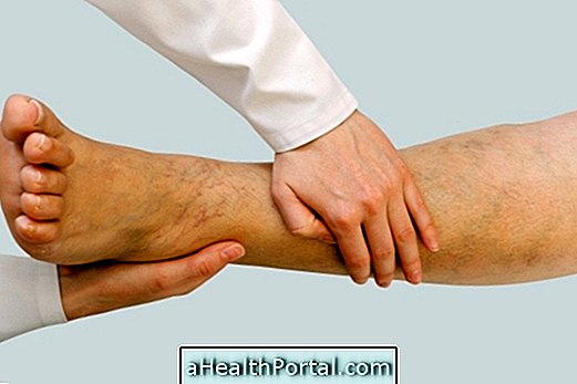 Consultați cauzele și modul de tratare a picioarelor umflate