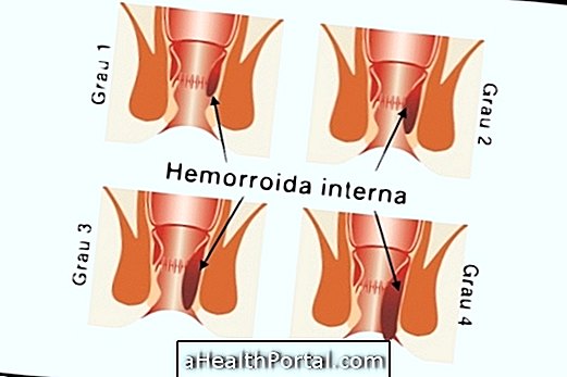 Vaadake, kuidas hemorroidid kõrvaldada valu katkestamiseks