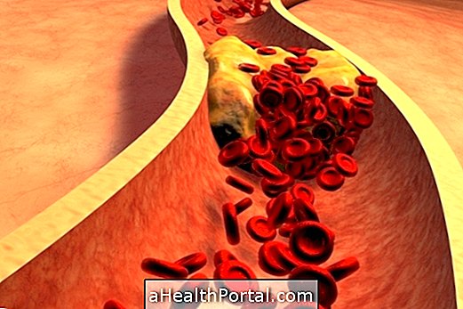 Hoe te verlagen triglyceriden om hartaanval te voorkomen