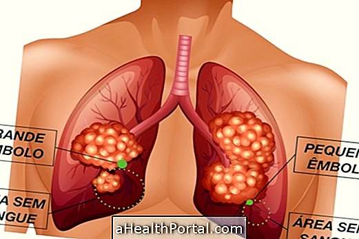 Conséquences de l'embolie pulmonaire