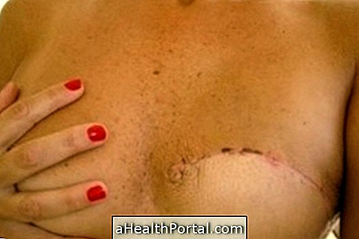 स्तन पुनर्निर्माण कैसे किया जाता है?