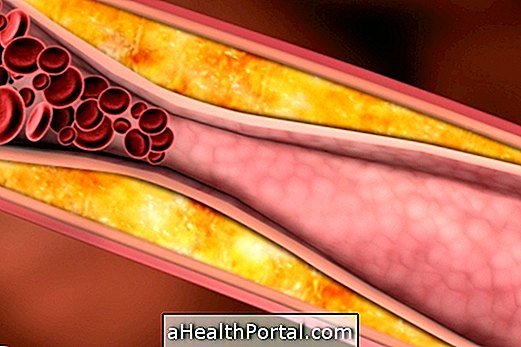 Kolesterolin tyypit ja vertailuarvot