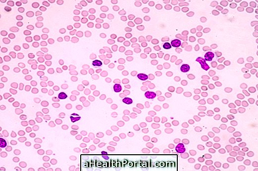 Chronic Lymphoid Leukemia: What It Is, Symptoms and Treatment