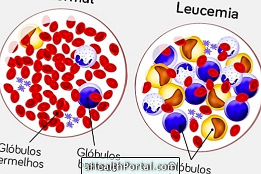 Symptômes de la leucémie aiguë et mode de traitement