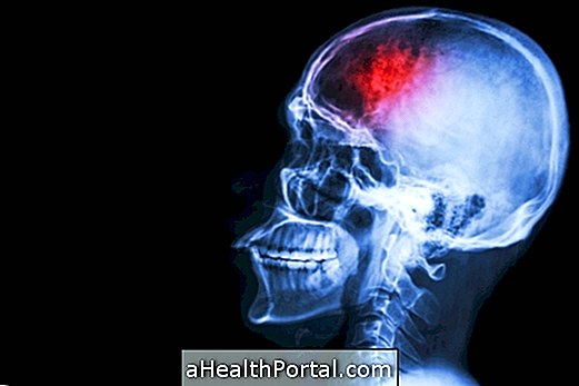 Cerebral haemorrhage: symptoms, causes and possible sequelae