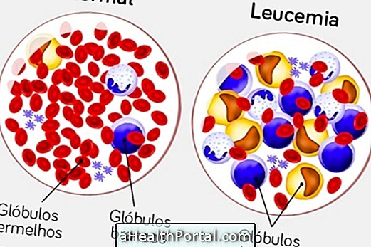 Što je leukemija, vrste, uzroci, dijagnoza, liječenje i liječenje