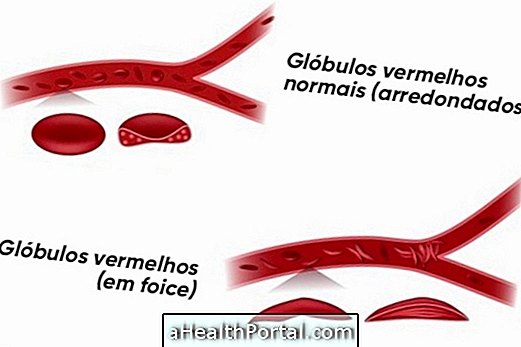 What is sickle cell anemia, causes and how is treatment done
