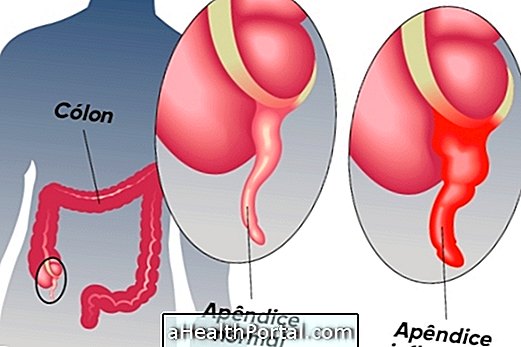 Hvad er akut appendicitis og større symptomer