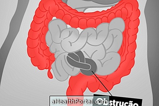 Qu'est-ce qu'une occlusion intestinale et comment la traiter?