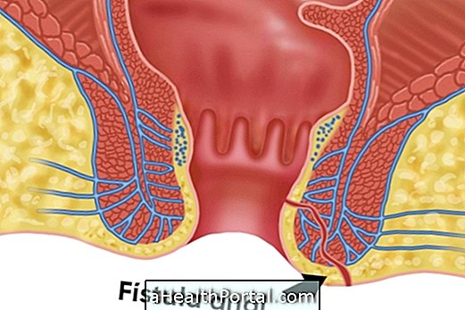 Što je analni fistula i kako se njome liječiti
