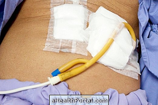 What is gastrostomy and how to take care of the catheter