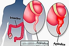 Pain of appendicitis: know what to do