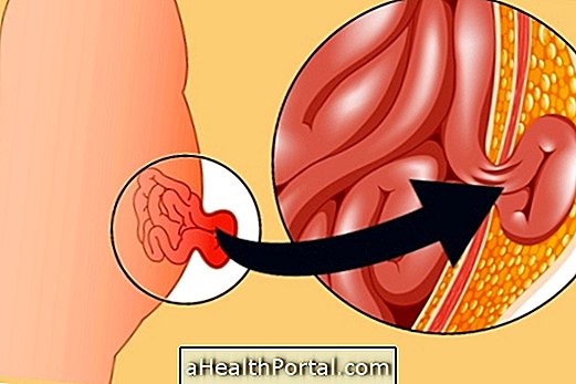 Hvordan man identificerer og behandler abdominal brok