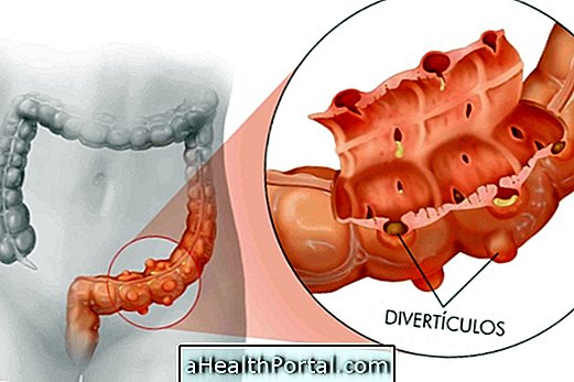 A Diverticulosis fő tünetei és kezelése