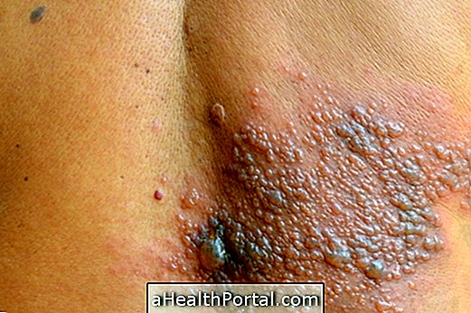 Mikä on ja miten hoidetaan dermatiitti herpetiformis