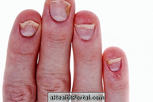 Behandling av psoriasis i naglarna